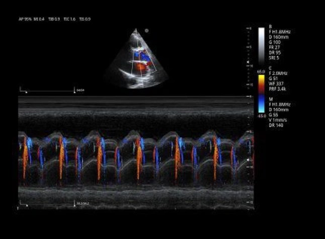 Cardiaco PW Doppler